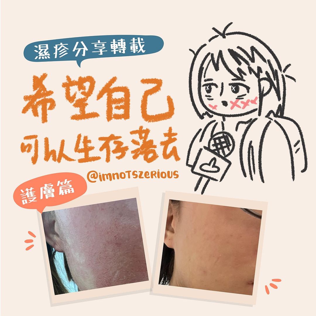【Cubed產品評價】我的濕疹康復之路,從害怕見人到恢復自信