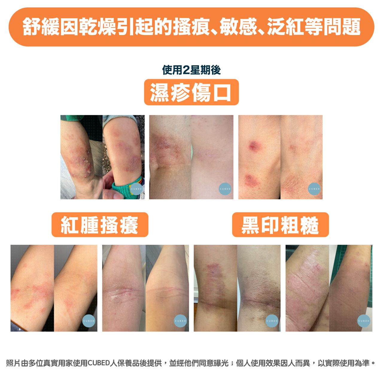 氧化鋅保濕紓緩布帶