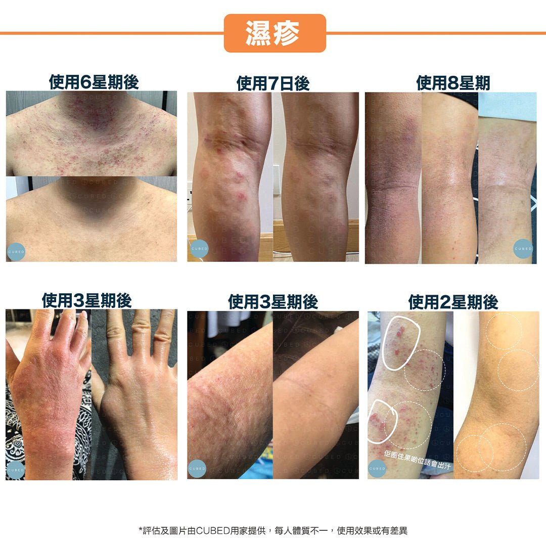 Cubed 雙層修護身體組合 - 迅速紓緩濕疹發炎黑印紅腫紅疹及滲水傷口 | 濕疹肌、類固醇戒斷推薦 | 過千用家回圖證實
