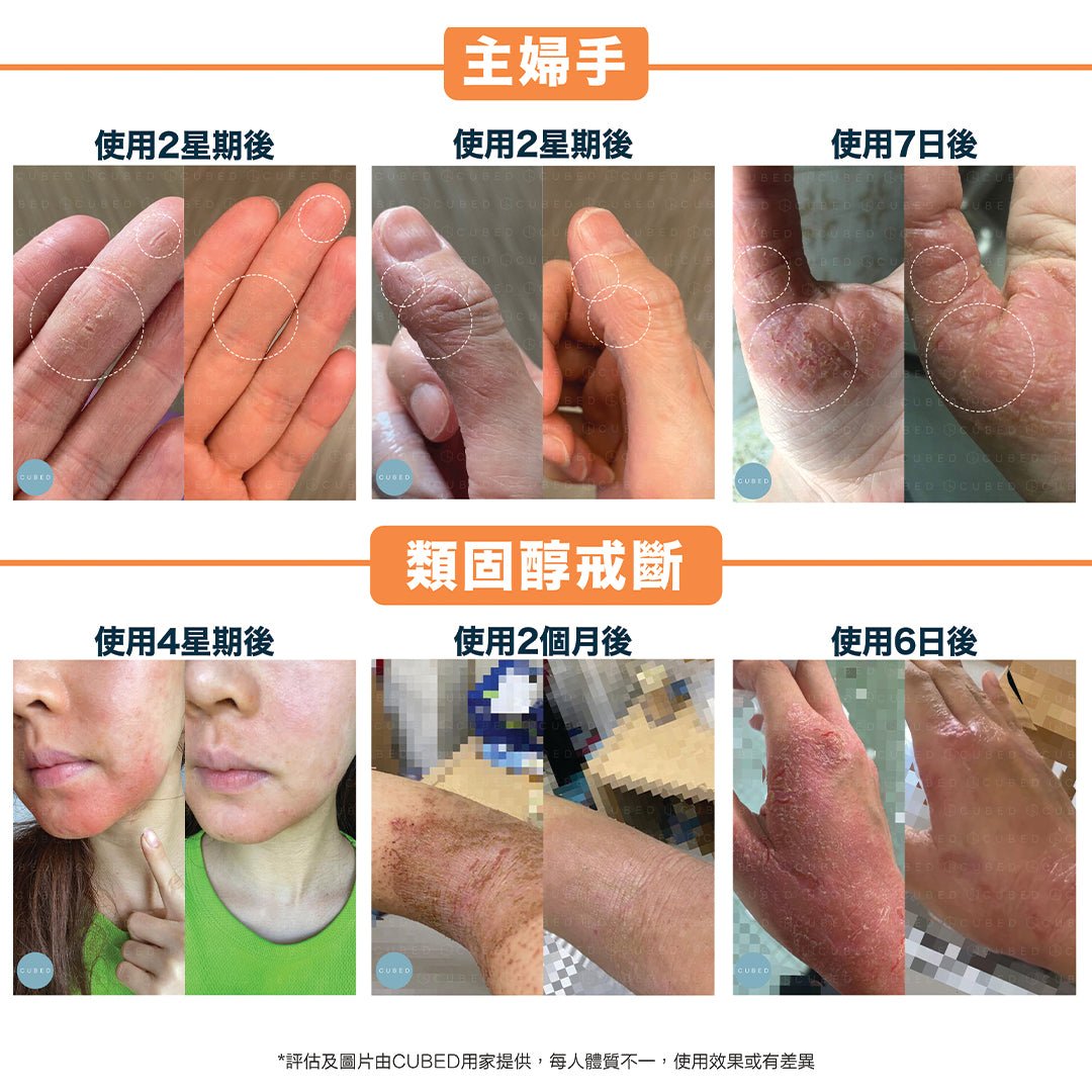 Cubed 雙層修護身體組合 - 迅速紓緩濕疹發炎黑印紅腫紅疹及滲水傷口 | 濕疹肌、類固醇戒斷推薦 | 過千用家回圖證實
