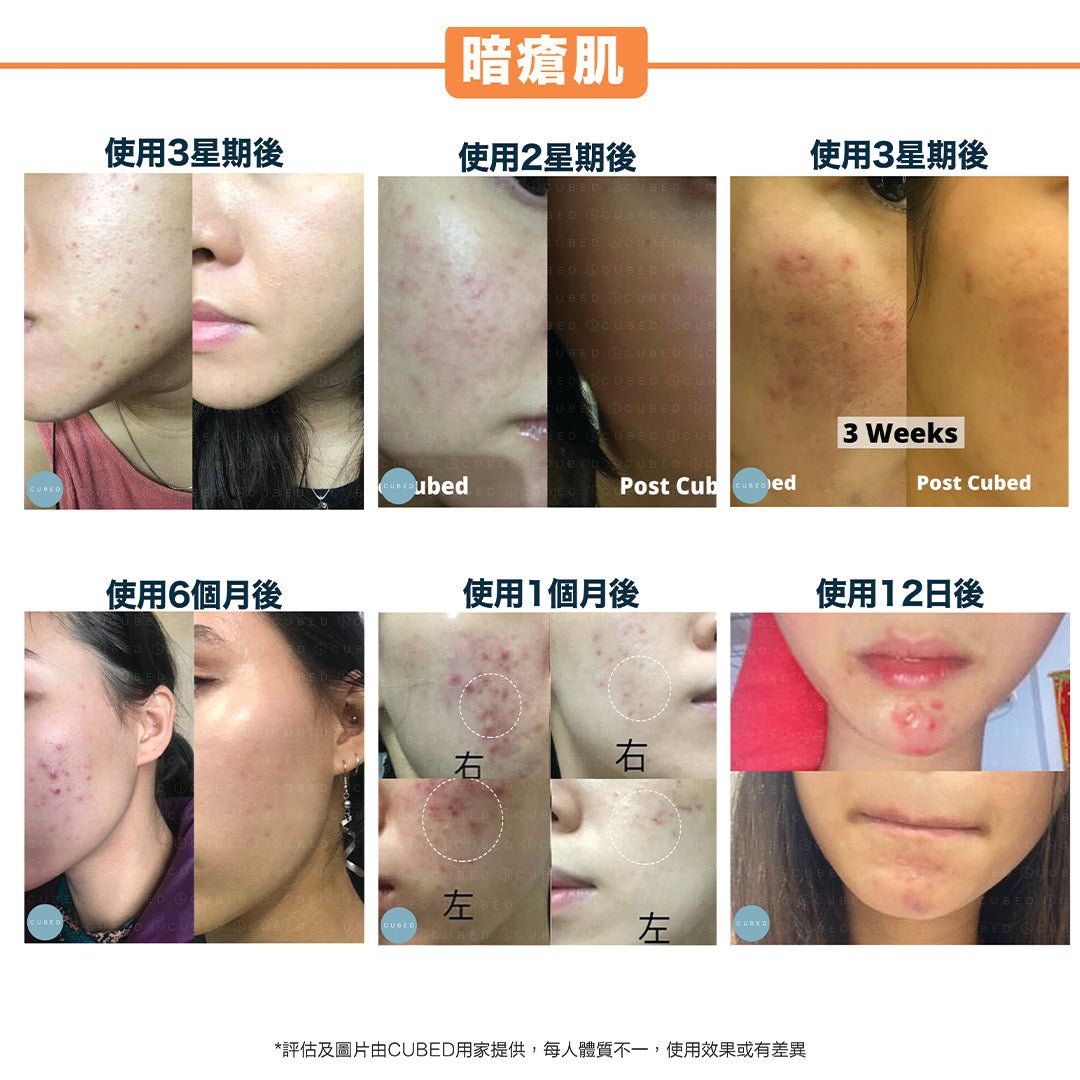 Cubed 柔膚光澤組合 - 紓緩敏感泛紅及減淡色素沉澱,美白提升光澤 | 敏感肌、暗瘡肌推薦 | 過千用家回圖證實