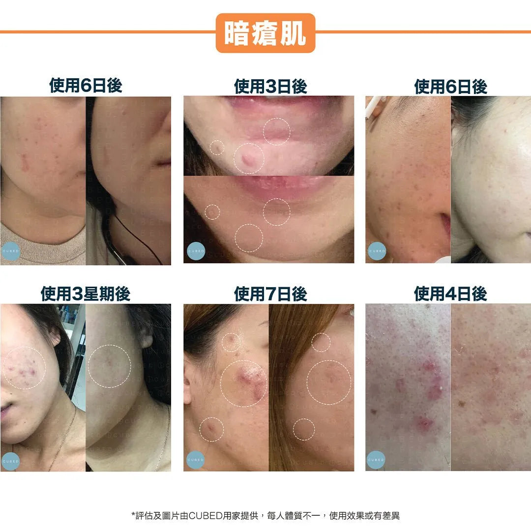 Cubed Spot Treatment 高濃度定點修復油 - 修復暗瘡石頭瘡及濕疹傷口 | 暗瘡肌、濕疹肌推薦 | 過千用家回圖證實