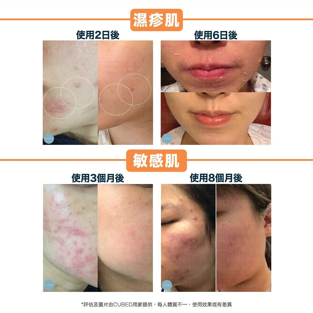 Cubed Spot Treatment 高濃度定點修復油 - 修復暗瘡石頭瘡及濕疹傷口 | 暗瘡肌、濕疹肌推薦 | 過千用家回圖證實