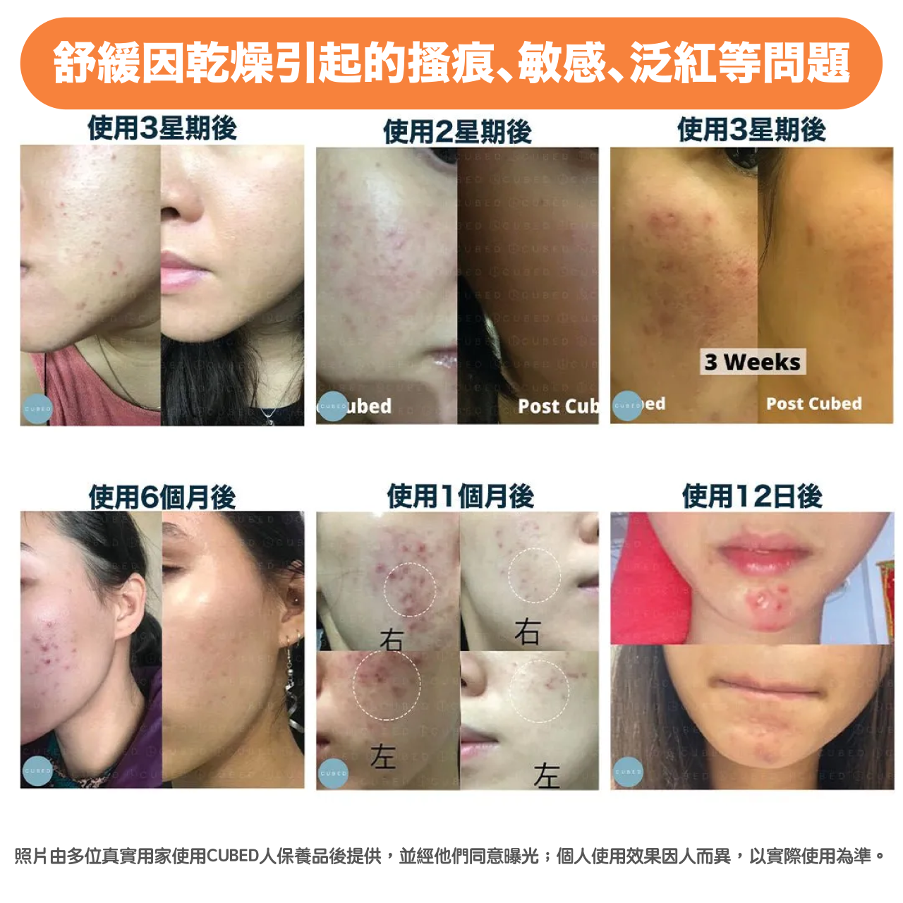 高濃度暗瘡組合